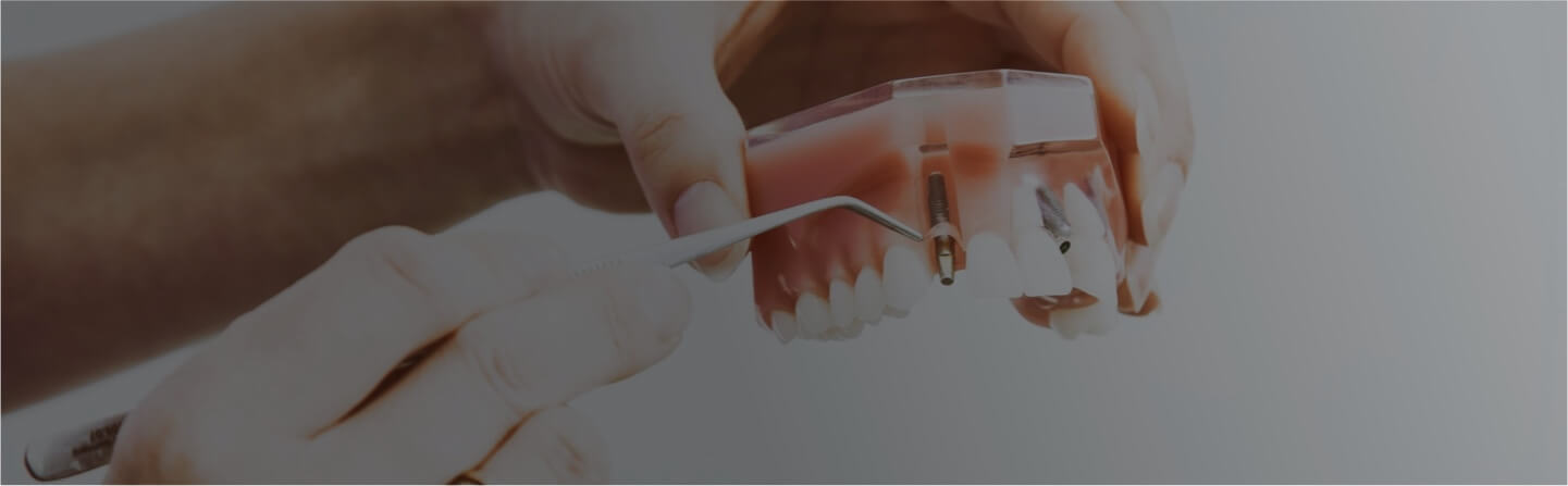 Prótesis Dental